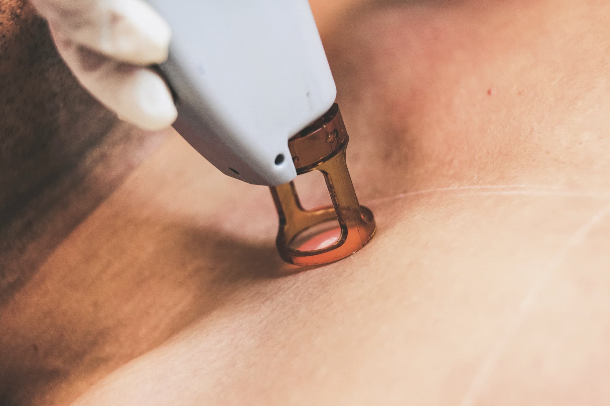 Gloved hand guiding a laser handpiece across the skin